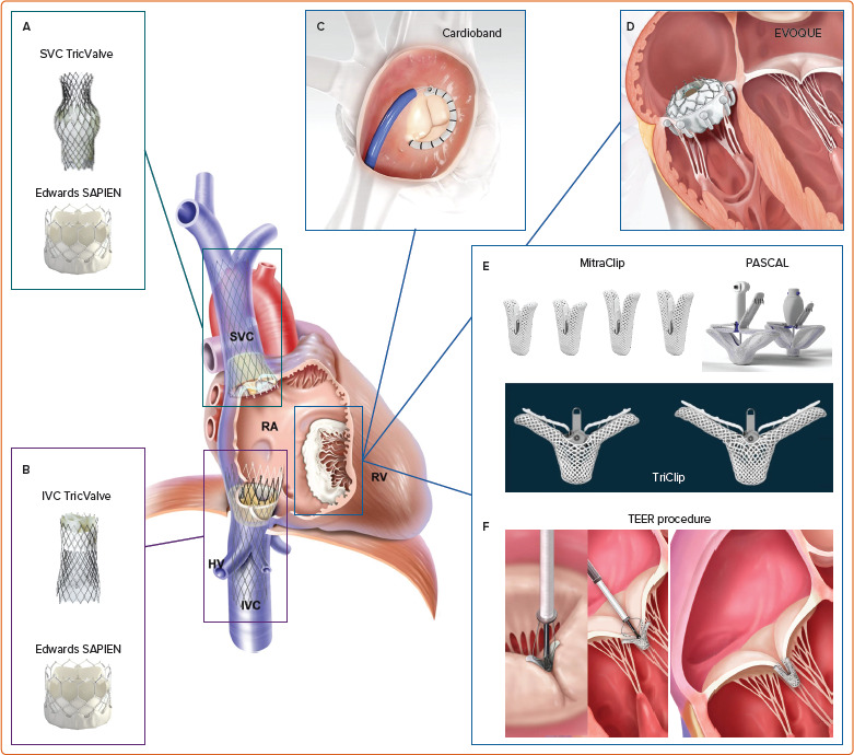 Tricuspid Regurgitation: Disease State and Advances in Percutaneous Therapy.