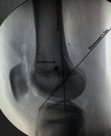 Reimagined MPFL Reconstruction: Retinacular Fixation of the Doubled Hamstring Graft at the Patella and Suture Anchor-Based Femoral Fixation.