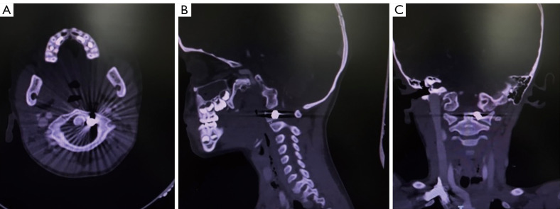 Air-gun pellet at C1: a case report and literature review.