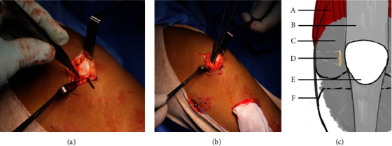 Reimagined MPFL Reconstruction: Retinacular Fixation of the Doubled Hamstring Graft at the Patella and Suture Anchor-Based Femoral Fixation.