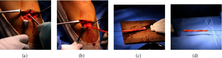 Reimagined MPFL Reconstruction: Retinacular Fixation of the Doubled Hamstring Graft at the Patella and Suture Anchor-Based Femoral Fixation.