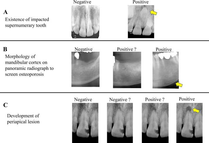 Deep learning and artificial intelligence in dental diagnostic imaging