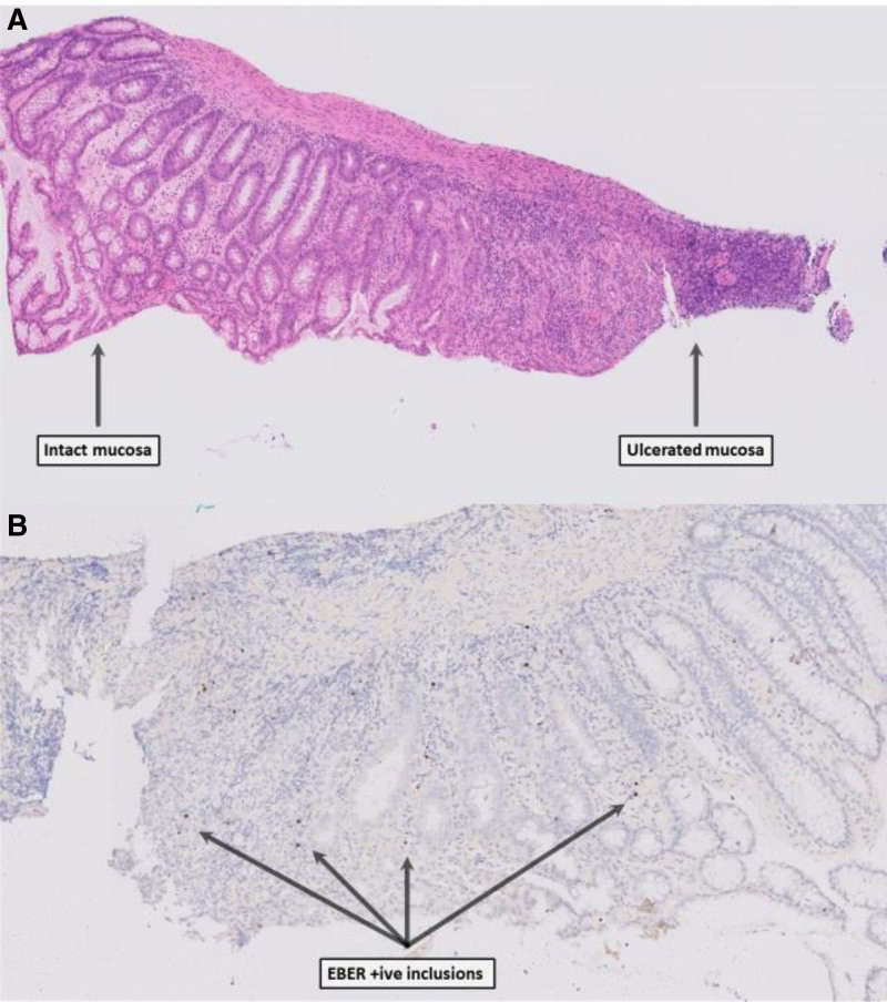 Donor-derived Epstein-Barr Virus Mucocutaneous Ulceration: A Unique and Complex Case of Rectal Hemorrhage.