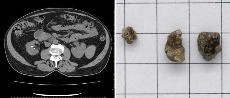 First Reported Case of a Pyrophosphate Kidney Stone in a Human.