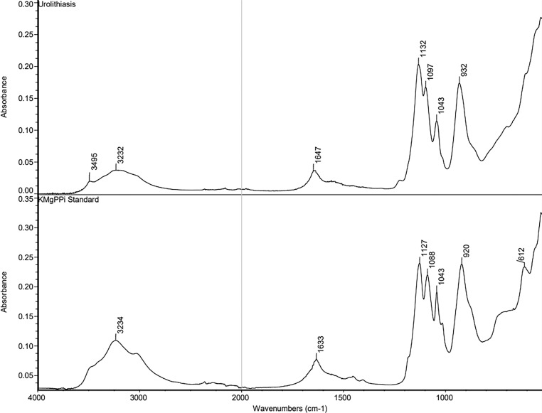 First Reported Case of a Pyrophosphate Kidney Stone in a Human.