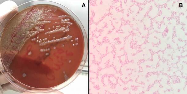 Bacteremia by non-O1/non-O139 Vibrio cholerae: Case description and literature review.