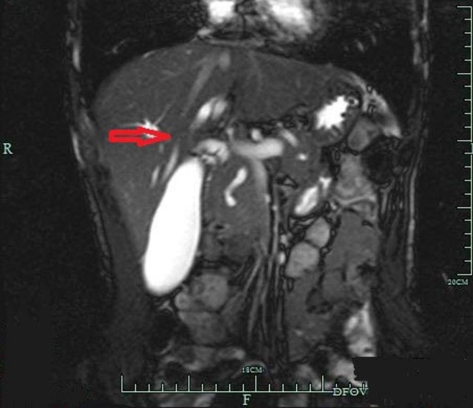 Periampullary tumors in a patient with pancreatic divisum and neurofibromatosis type 1: a case report.