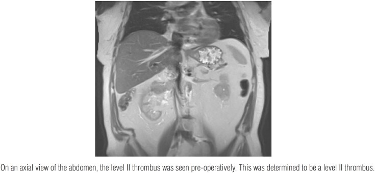 Robotic assisted radical nephrectomy with Inferior vena cava tumor thrombus.