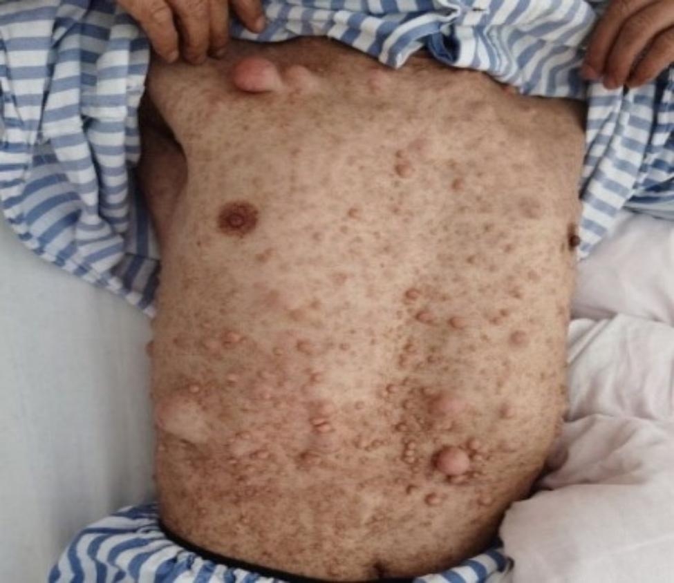 Periampullary tumors in a patient with pancreatic divisum and neurofibromatosis type 1: a case report.