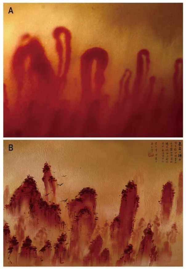 Active pattern on nailfold capillaroscopy in a patient with systemic sclerosis.