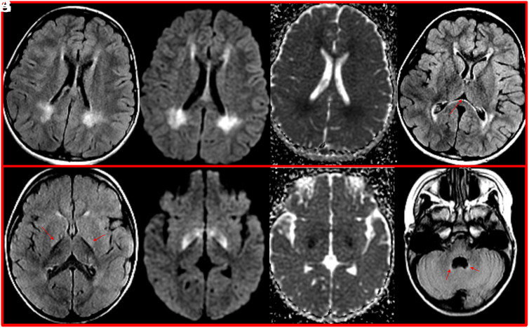 Phenylketonuria: A Scoring System for Brain Magnetic Resonance Imaging.