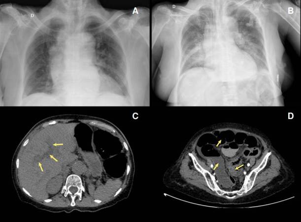 Bacteremia by non-O1/non-O139 Vibrio cholerae: Case description and literature review.