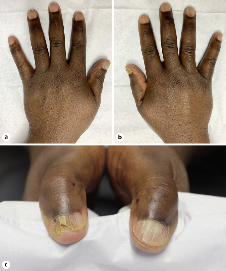 Bullous Lichen Planus of the Nails: A Case Report and Review of the Literature.