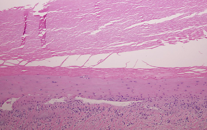 Bullous Lichen Planus of the Nails: A Case Report and Review of the Literature.