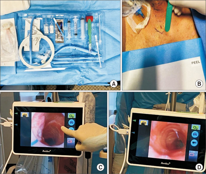 Percutaneous Dilatational Tracheostomy in a Cardiac Surgical Intensive Care Unit: A Single-Center Experience.