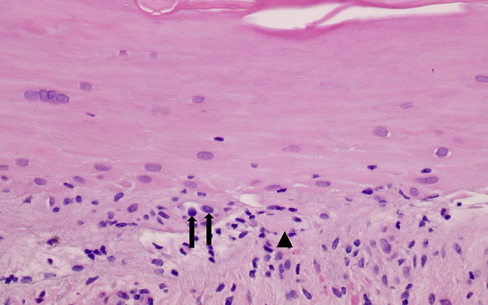 Bullous Lichen Planus of the Nails: A Case Report and Review of the Literature.