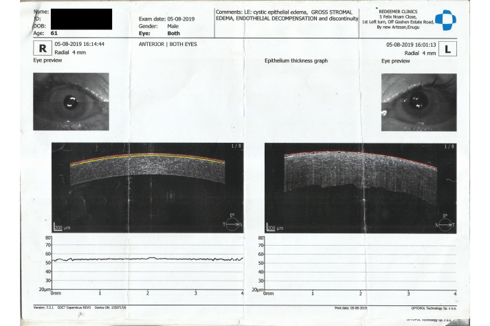 Toxic anterior segment syndrome following trabeculectomy with mitomycin C.