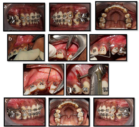 Evaluation of the Difference in the Rate of Canine Retraction Assisted by Piezocision and Discission in Human Subjects: A Preliminary Parallel-Arm Prospective Clinical Study.