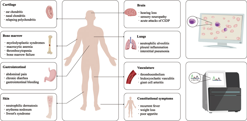 VEXAS Syndrome-Review.