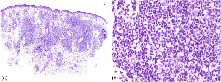 The enigmatic ear: Unveiling a rare case of a primary cutaneous CD8+ acral T-cell lymphoproliferative disorder with a literature review.