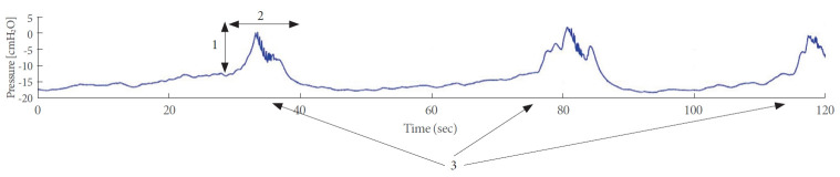 Transcutaneous Electrical Stimulation of the Abdomen, Ear, and Tibial Nerve Modulates Bladder Contraction in a Rat Detrusor Overactivity Model: A Pilot Study.