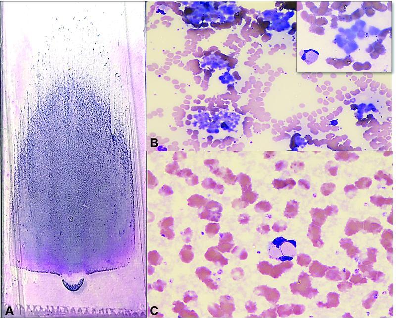 Cryoglobulinemia Diagnosed by Peripheral Smear Examination: Value of a Basic Underestimated Test.