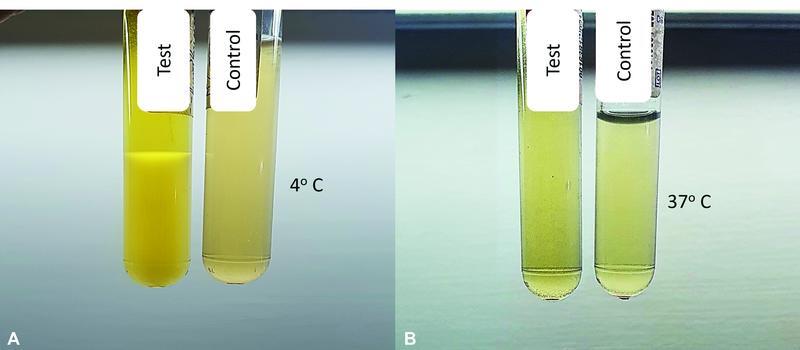 Cryoglobulinemia Diagnosed by Peripheral Smear Examination: Value of a Basic Underestimated Test.