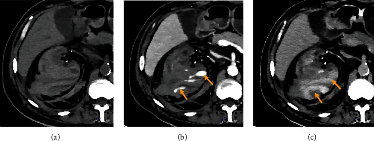 Spontaneous Subcapsular Renal Hematoma as Cause of Hypovolemic Shock in a Chronic Hemodialysis Patient.