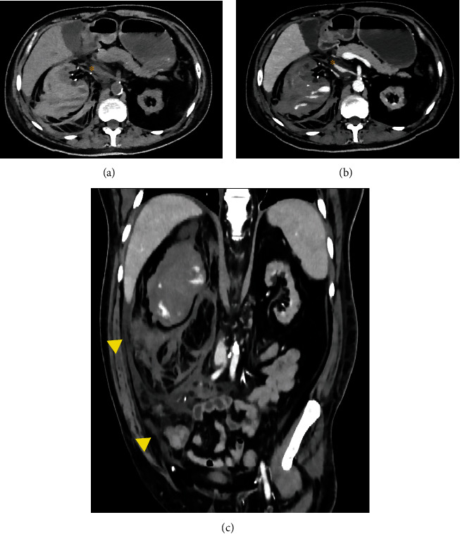 Spontaneous Subcapsular Renal Hematoma as Cause of Hypovolemic Shock in a Chronic Hemodialysis Patient.