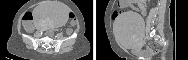 Sertoliform endometrioid carcinoma of the right ovary.