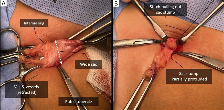 Selective anterior annuloplasty during inguinal herniotomy in boys: an approach to further reduce hernia recurrence.