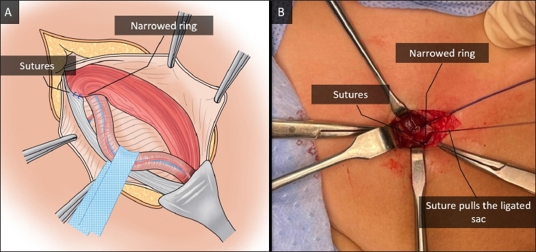 Selective anterior annuloplasty during inguinal herniotomy in boys: an approach to further reduce hernia recurrence.