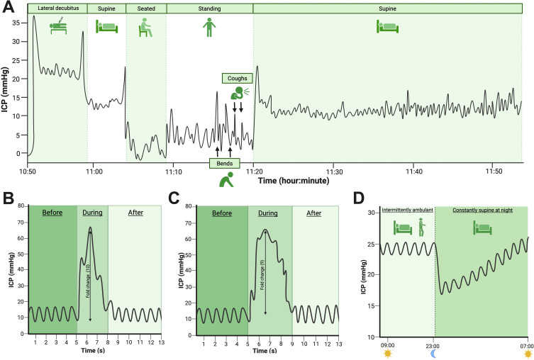 A Neuro-Ophthalmologist's Guide to Advances in Intracranial Pressure Measurements.