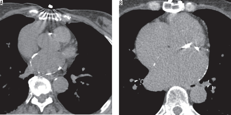 Left atrial calcification on chest CT: atrial ablation replaces rheumatic heart disease as the most identified etiology.