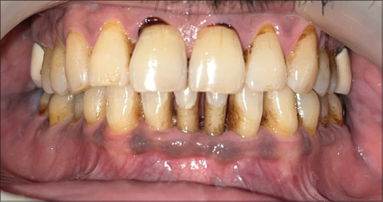 Emerging role of photodynamic therapy as an adjunct to nonsurgical periodontal therapy on periodontal status and glycemic control in patients with type 2 diabetes: A clinical study.