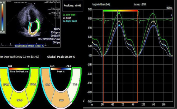 The correlation between epicardial fat thickness and longitudinal left atrial reservoir strain in patients with type 2 diabetes mellitus and controls.