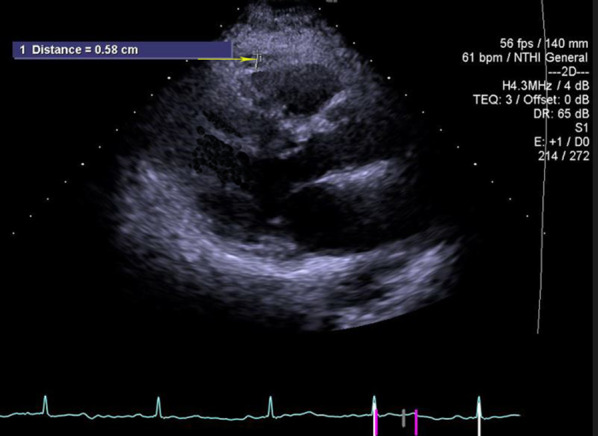 The correlation between epicardial fat thickness and longitudinal left atrial reservoir strain in patients with type 2 diabetes mellitus and controls.