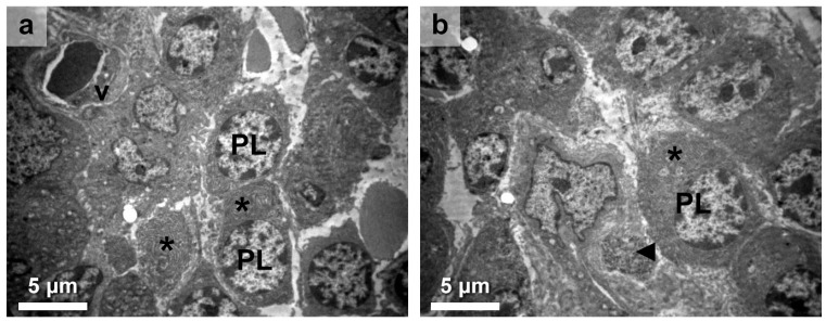 Histological Alterations in Hashimoto's Disease: A Case-Series Ultrastructural Study.