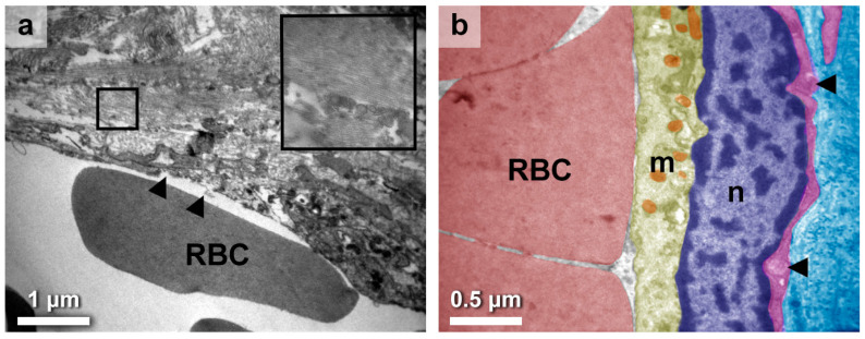 Histological Alterations in Hashimoto's Disease: A Case-Series Ultrastructural Study.