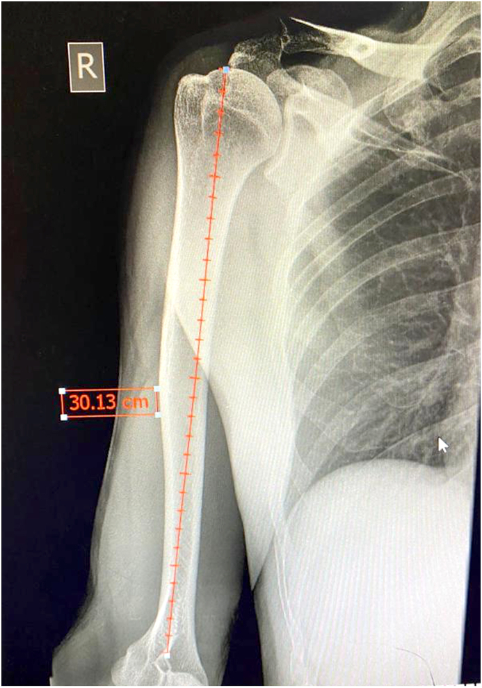 Preoperative estimation of humerus intramedullary nail length using clinical landmarks