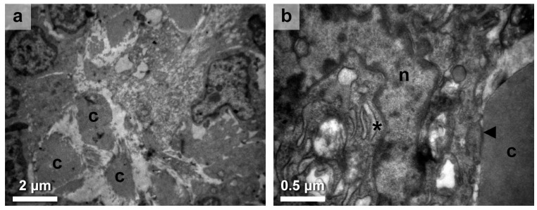 Histological Alterations in Hashimoto's Disease: A Case-Series Ultrastructural Study.