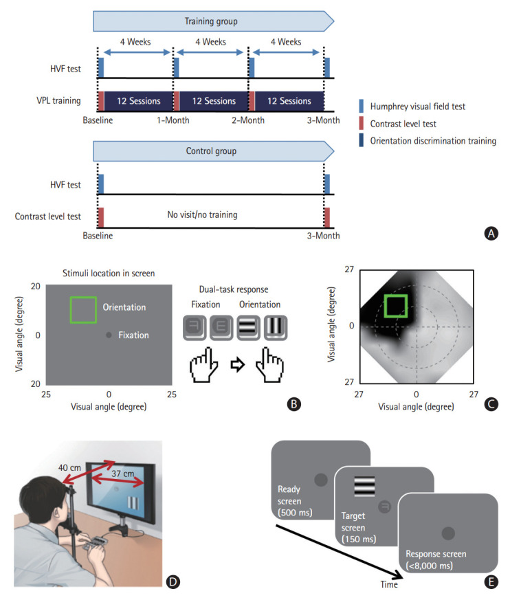 Digital Therapeutics With Visual Discrimination Training for Cortical Blindness in Patients With Chronic Stroke.