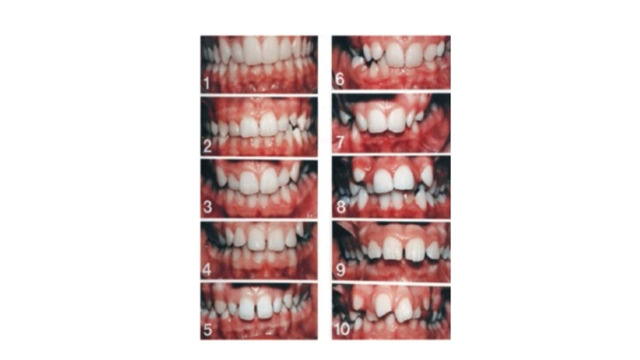 Assessment of Relationship between Intelligence Quotient and Orthodontic Treatment Need.