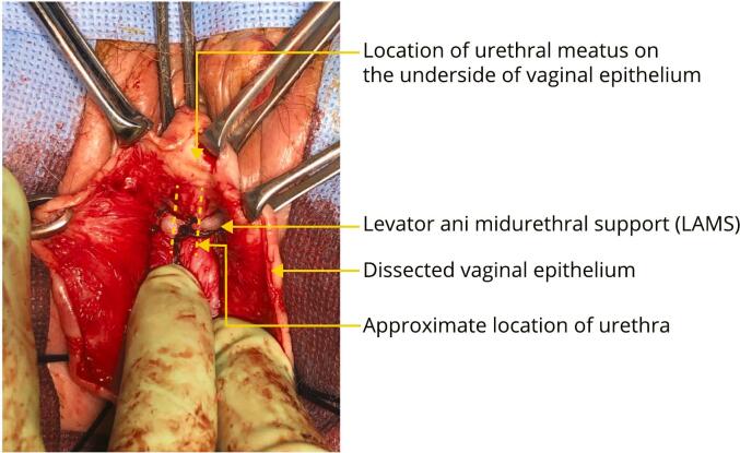 A levator ani midurethral support via single vaginal incision technique to treat stress urinary incontinence: A case report