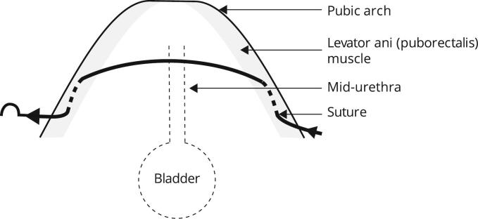 A levator ani midurethral support via single vaginal incision technique to treat stress urinary incontinence: A case report