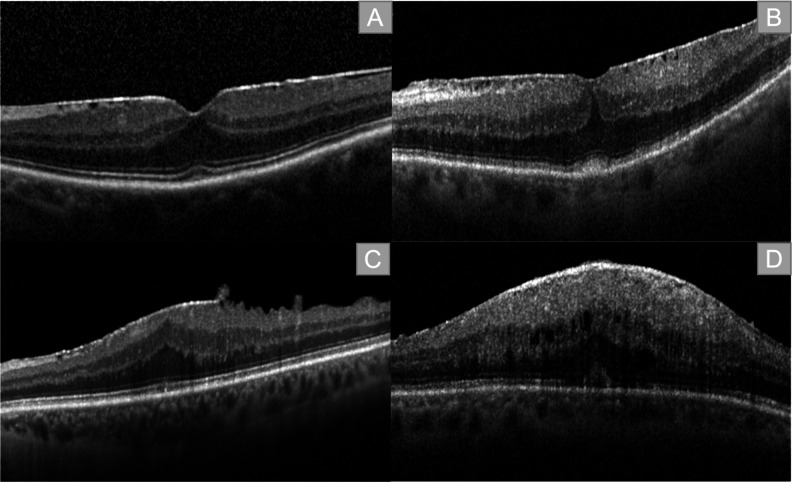 Short-term-outcomes of idiopathic epiretinal membranes treated with pars-plana-vitrectomy - examination of visual function and OCT-morphology.