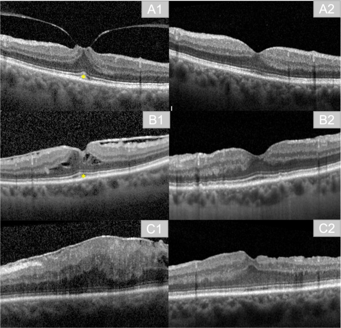 Short-term-outcomes of idiopathic epiretinal membranes treated with pars-plana-vitrectomy - examination of visual function and OCT-morphology.