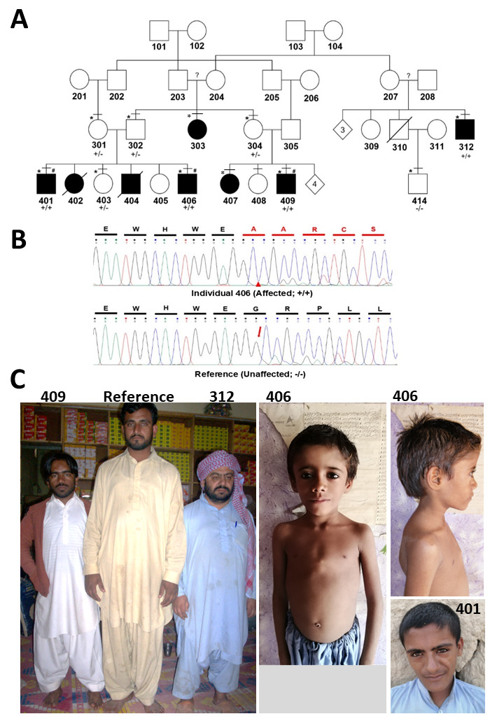 Expanding OBSL1 Mutation Phenotype: Disproportionate Short Stature, Barrel Chest, Thoracic Kyphoscoliosis, Hypogonadism, and Hypospadias.