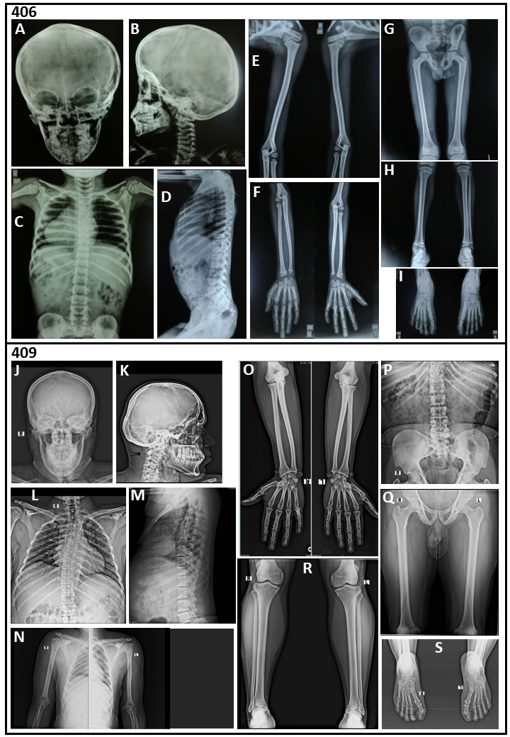 Expanding OBSL1 Mutation Phenotype: Disproportionate Short Stature, Barrel Chest, Thoracic Kyphoscoliosis, Hypogonadism, and Hypospadias.