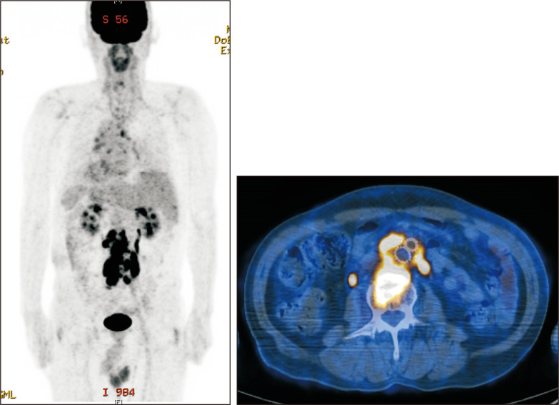 Aortic Endograft Infection: Diagnosis and Management.